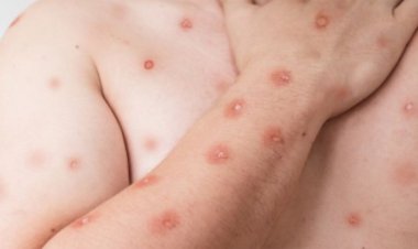 Ceará registra primeiro caso de mpox do ano; aponta monitoramento do Ministério da Saúde